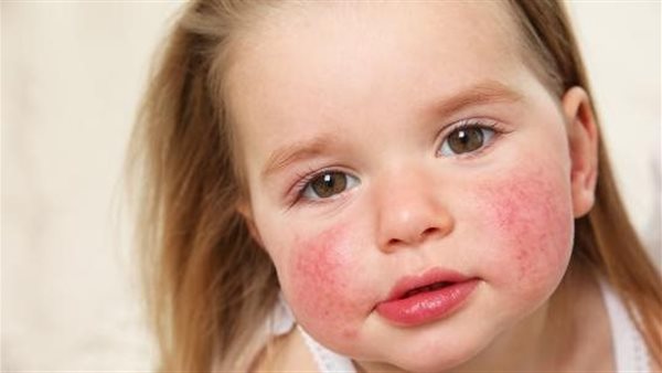 أعراض حساسية السمسم