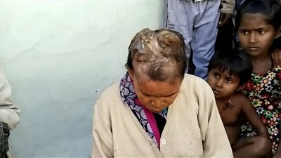 هندية ينمو في رأسها قرون نتيجة الإصابة بمرض نادر