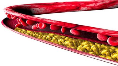 أبرزها آلام الساقين.. تعرف على أعراض الإصابة بدهون الدم