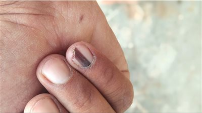 من بينها ظهور خط داكن اللون على الأظافر.. علامات تنذر بخطر الإصابة بسرطان الجلد