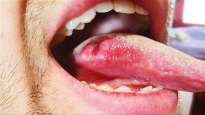 ظهور قرحة اللثة.. تعرف على أعراض سرطان الفم