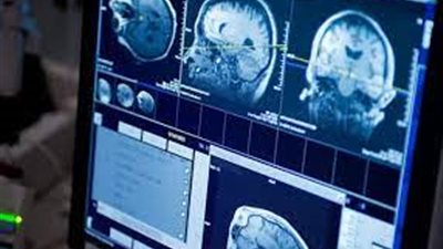 تقنية التصوير العصبي يمكن أن تكشف عن الاضطرابات العقلية | دراسة