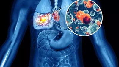 تقنية ذكاء اصطناعي يمكنها التنبؤ بمخاطر الإصابة بسرطان الرئة 