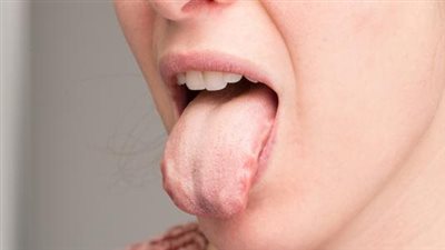منها لون اللسان.. علامات ارتفاع مستويات الكوليسترول في الدم