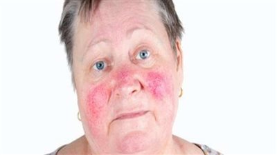 وصفوها بالطماطم.. ما هو مرض الوردية الذي تعاني منه النساء في بريطانيا؟