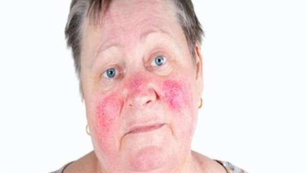 مرض الوردية 