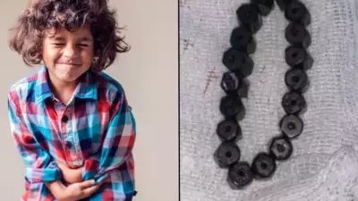 يتكون من 18 حبة.. استخراج سوار مغناطيسي من معدة طفل في عمر الـ 4 سنوات