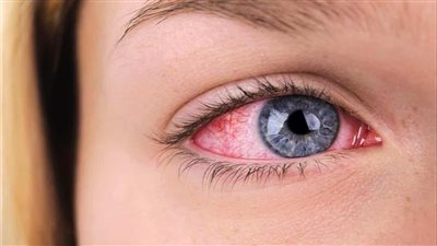 أصعب من آلام الولادة.. تعرف أعراض على متلازمة التهاب القرنية