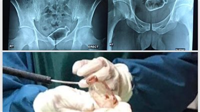 فريق طبي بالمنصورة يستخرج زجاجة من قولون رجل ظلت به لمدة أسبوعين.. الطبية تكشف التفاصيل