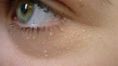 بثور الوجه.. كيف تنذر صحة البشرة بخطر الإصابة بمشاكل القلب؟