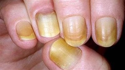 علامات تظهر على الأظافر تنذر بخطر الإصابة بالسكر