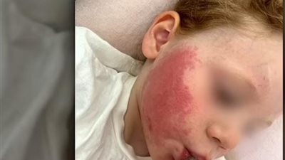 طفل بريطاني يصاب بحروق في وجهه بعد استخدام واقي الشمس