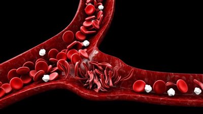 أبرزهم الثلاسيميا.. تعرف على أنواع فقر الدم