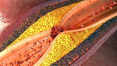 احذر.. السهر لوقت متأخر يعرضك للإصابة بانسداد الشرايين والسكتة الدماغية