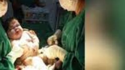 برازيلية مصابة بالسكري تلد طفلا عملاقا طوله قدمان ووزنه 7 كجم