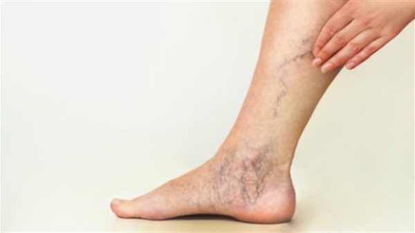 دوالي الساقين