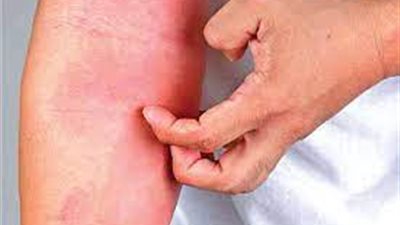 باحثون يطورون علاجًا مضادًا لبكتيريا الجلد | دراسة