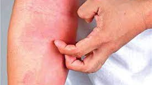 اللتهاب الجلد