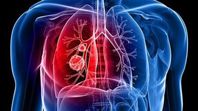 علامات تدل على الإصابة بسرطان الرئة تظهر في الصباح.. تعرف عليها