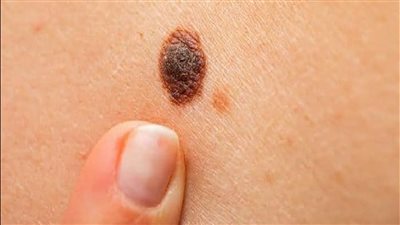 4 علامات غير شائعة تنذر بخطر الإصابة بسرطان الجلد.. تعرف عليها 