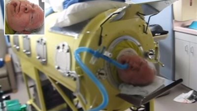 قضى 70 عام داخله.. رجل عاش داخل جهاز تنفس بعد إصابته بشلل الأطفال