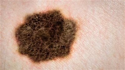 ظهور شامة غريبة.. تعرف على أعراض الإصابة بالورم الميلانيني