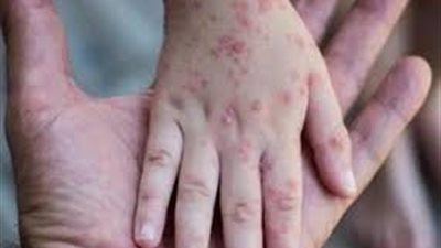 التعليم: الأوضاع آمنة بمدارس المنوفية بعد السيطرة على حالات الجدري السابقة