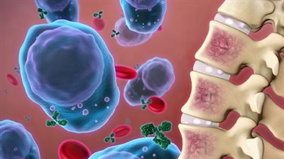 يصيب العظام ويؤدي إلى الوفاة.. تعرف على أعراض أخطر الأورام السرطانية