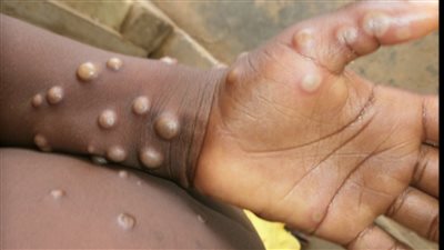 بالرغم من انتهاء حالة الطوارئ العالمية.. باكستان تشهد ارتفاعًا في إصابات فيروس جدري القرود