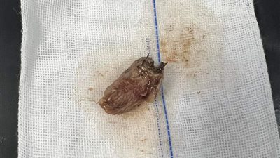 لانسداد مجرى الهواء.. وفاة طفل عمره عامين لابتلاعه قطعة فراولة 