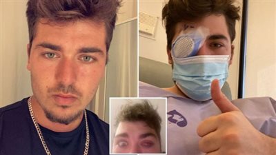 فرط إفراز الدموع.. أبرز أعراض الإصابة بالتهاب القرنية