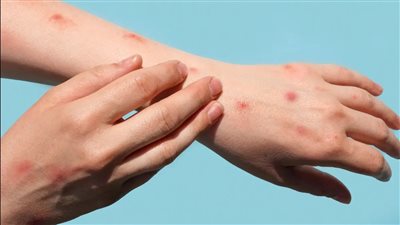 باكستان تعلن خلوها من فيروس جدري القرود بعد تعافي الإصابتين