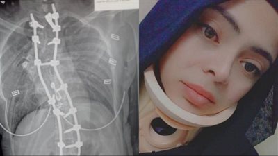 فتاة سورية تستغيث بطبيب عظام مصري