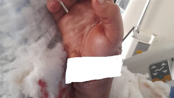 اليد المبتورة