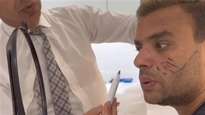 رامي صبري يخضع لجراحة تجميل في الوجه 
