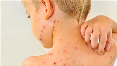 وفاة طفل أمريكي بسبب مضاعفات نادرة للحصبة.. ومسؤولو الصحة يحذرون