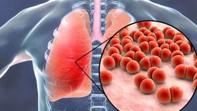 بعد زيادة حالات السل في بريطانيا.. خبراء: السعال المستمر قد يكون علامة للمرض