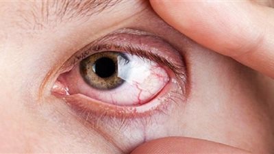 خبراء: تدليك الجفون يساعد في تخفيف جفاف العين