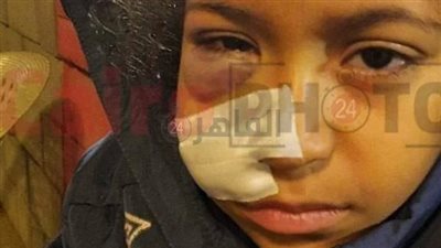 بعد نشر القاهرة 24.. مدير الأهلي بمدينة نصر يعد بعلاج طفلة تعرضت لحادث داخل النادي