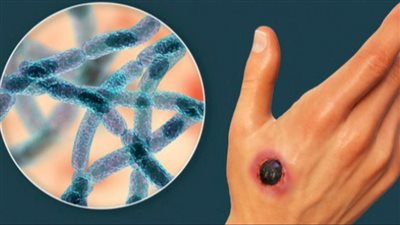 بعد ظهورها في تشوفاش الروسية.. وباء الجمرة الخبيثة يضرب موسكو وينذر بكارثة صحية