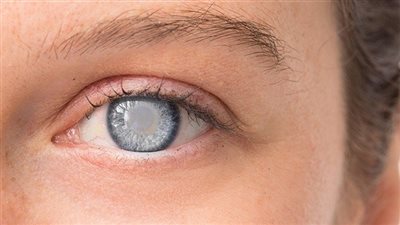 موجة من الوفيات وفقدان البصر بسبب قطرة للعين في أمريكا 