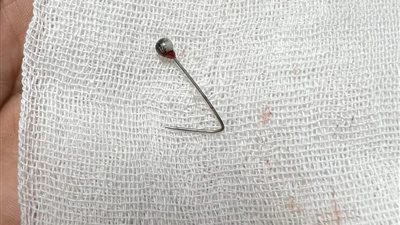 استقر بالرئة.. إنقاذ فتاة ابتلعت دبوس طرحة بمستشفى بنها الجامعي| صور 