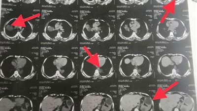 تفاصيل إنقاذ حياة سيدة وشاب بجراحتين بمستشفى بنها الجامعي