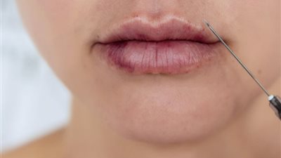 شيرين تخلع زوجها: مش راضي يدفع لى حق الفيلر والبوتكس