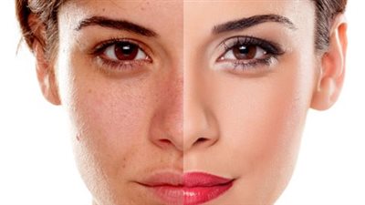 تعرف على أعراض وطرق علاج تضرر البشرة من أشعة الشمس 